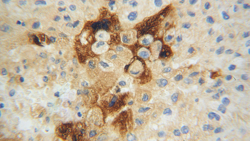 Immunohistochemical of paraffin-embedded human liver cancer using Catalog No:108038(APOH antibody) at dilution of 1:100 (under 40x lens)