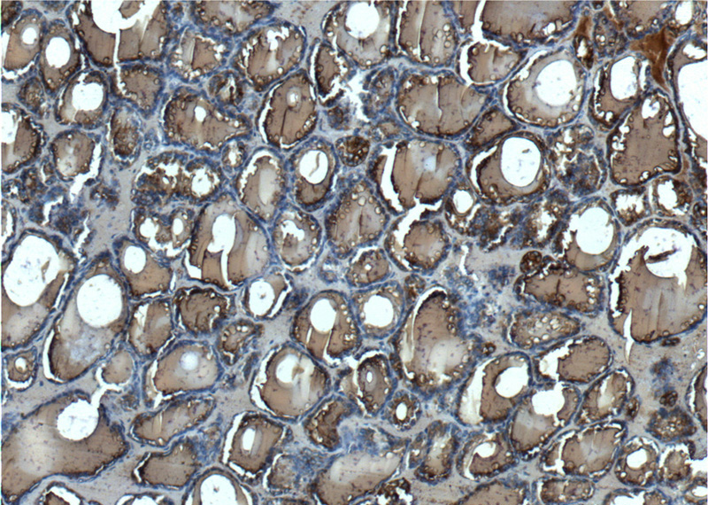 Immunohistochemistry of paraffin-embedded human thyroid tissue slide using Catalog No:116117(TG Antibody) at dilution of 1:200 (under 10x lens).