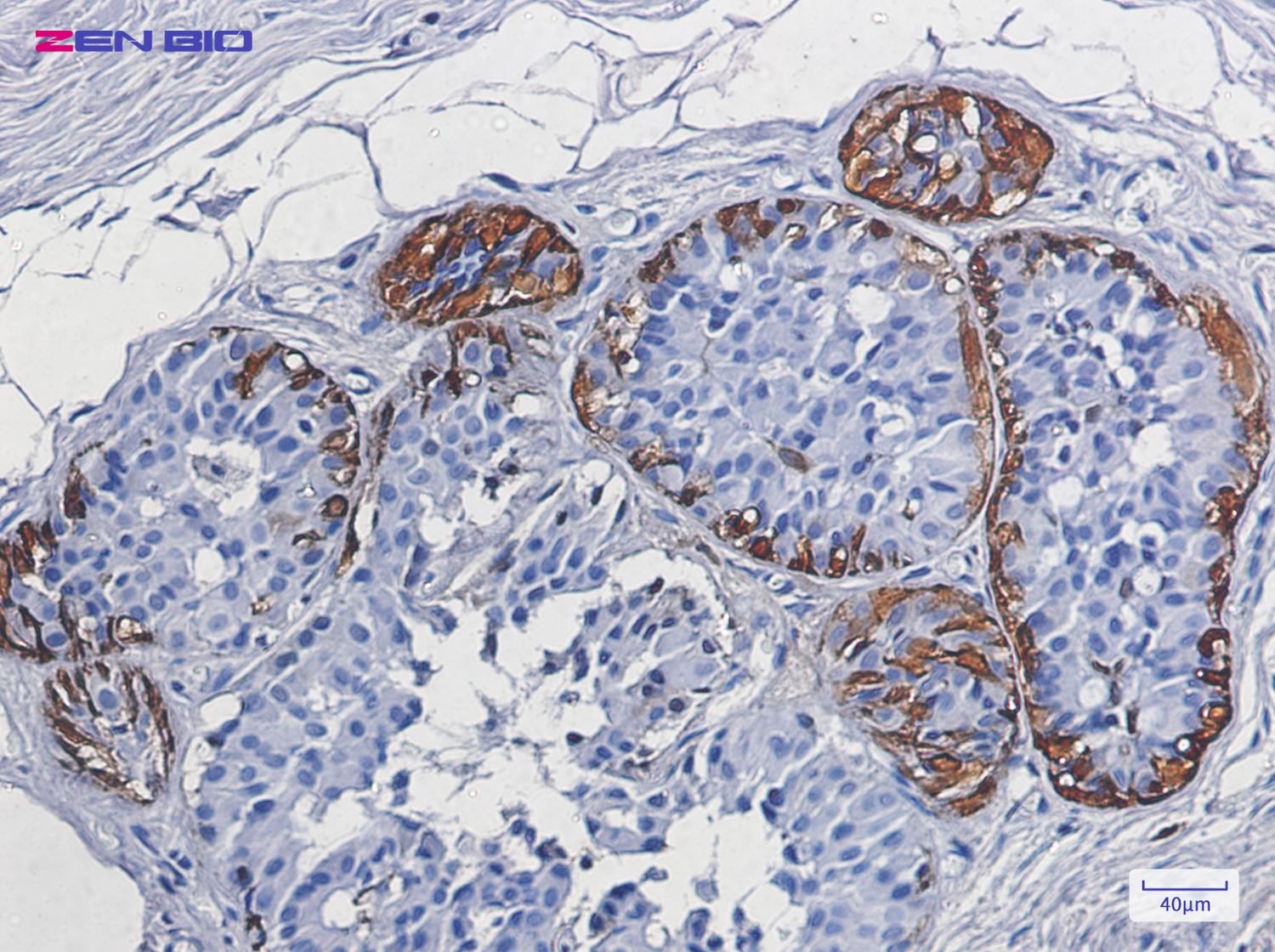 Immunohistochemistry of S100 beta in paraffin-embedded Human breast cancer tissue using S100 beta Rabbit pAb at dilution 1/50
