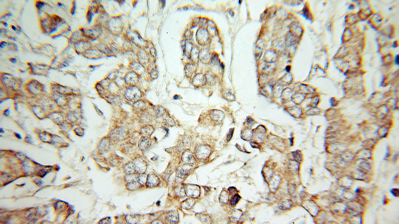 Immunohistochemical of paraffin-embedded human breast cancer using Catalog No:116634(UQCRB antibody) at dilution of 1:100 (under 10x lens)