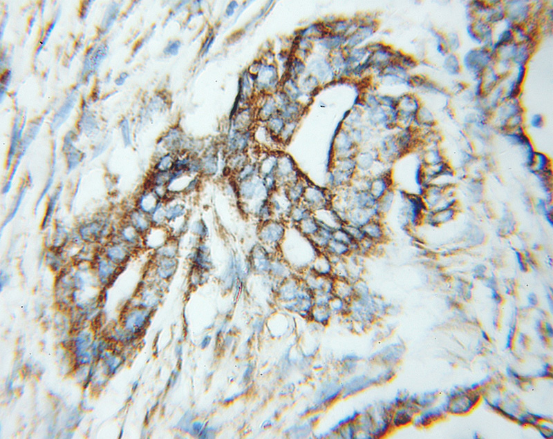 Immunohistochemical of paraffin-embedded human pancreas cancer using Catalog No:116219(TPST2 antibody) at dilution of 1:100 (under 10x lens)