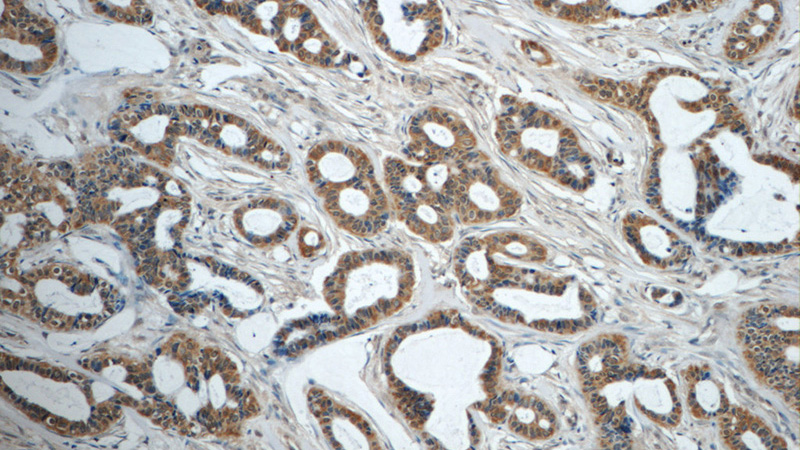 Immunohistochemistry of paraffin-embedded human breast cancer tissue slide using Catalog No:107629(TNF-a Antibody) at dilution of 1:50 (under 10x lens)