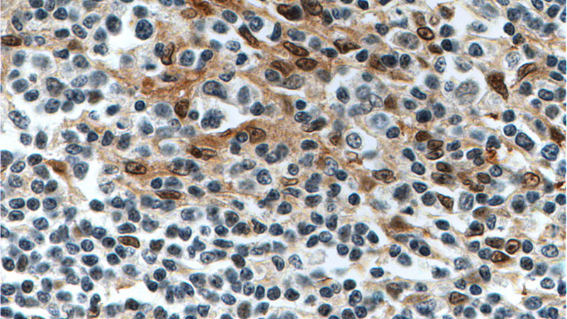 Immunohistochemistry of paraffin-embedded human lymphoma tissue slide using Catalog No:110687(FLI1 Antibody) at dilution of 1:200 (under 40x lens). heat mediated antigen retrieved with Tris-EDTA buffer(pH9).