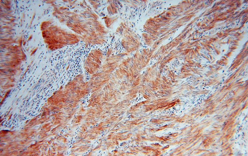Immunohistochemical of paraffin-embedded human colon cancer using Catalog No:111701(HSPB7 antibody) at dilution of 1:50 (under 10x lens)