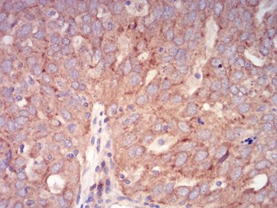 Fig7: Immunohistochemical analysis of paraffin-embedded human ovarian cancer tissue using anti-Rab6b antibody. Counter stained with hematoxylin.