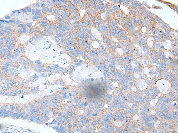The image is immunohistochemistry of paraffin-embedded Human colorectal cancer tissue using 169082(IFNGR1 Antibody) at dilution 1/30, on the right is treated with synthetic peptide. (Original magnification: ×200)