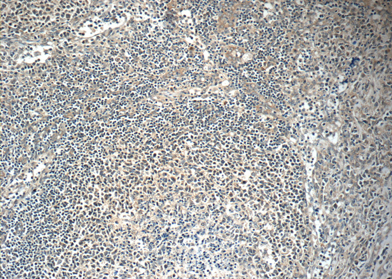 Immunohistochemistry of paraffin-embedded human lymphoma tissue slide using Catalog No:110545(FBXL18 Antibody) at dilution of 1:50 (under 10x lens)
