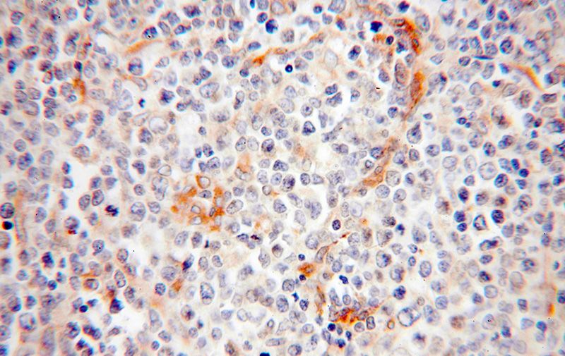 Immunohistochemical of paraffin-embedded human lymphoma using Catalog No:108420(BCAP29 antibody) at dilution of 1:200 (under 40x lens)