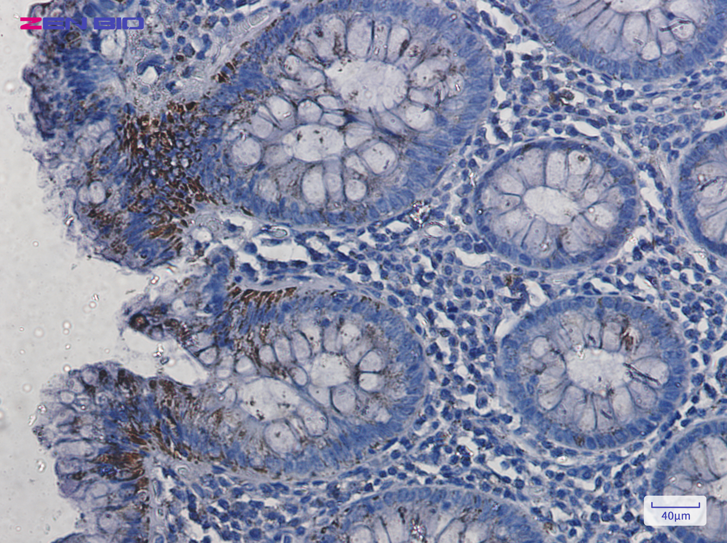 Immunohistochemistry of VDAC1 in paraffin-embedded Human colon cancer tissue using VDAC1 Rabbit pAb at dilution 1/50