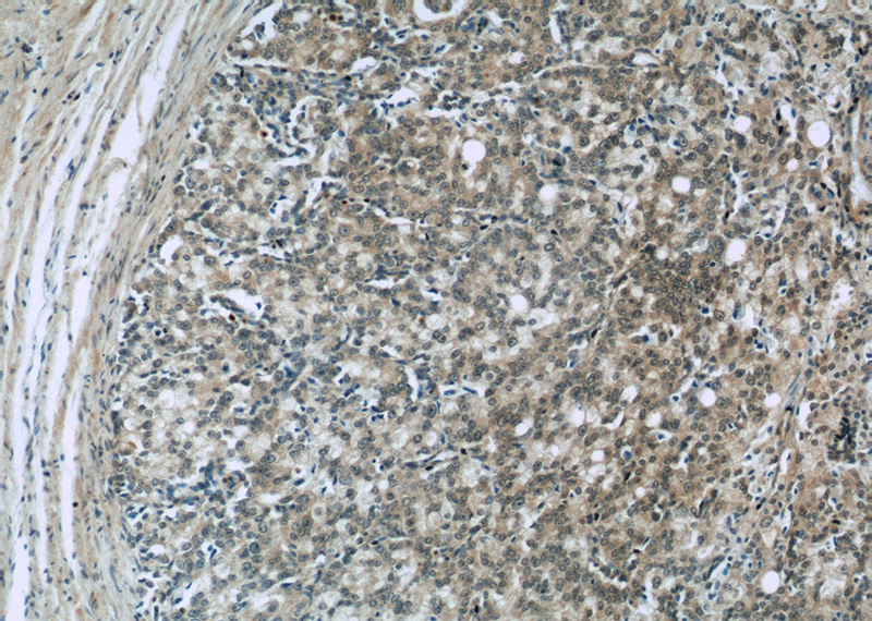 Immunohistochemistry of paraffin-embedded human prostate cancer slide using Catalog No:116414(TRPS1 Antibody) at dilution of 1:50