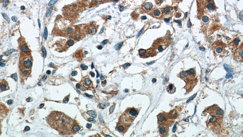 Immunohistochemistry of paraffin-embedded human breast cancer tissue slide using Catalog No:107504(EBAG9 Antibody) at dilution of 1:50. Heat mediated antigen retrieved with Citric acid buffer, pH6.0.