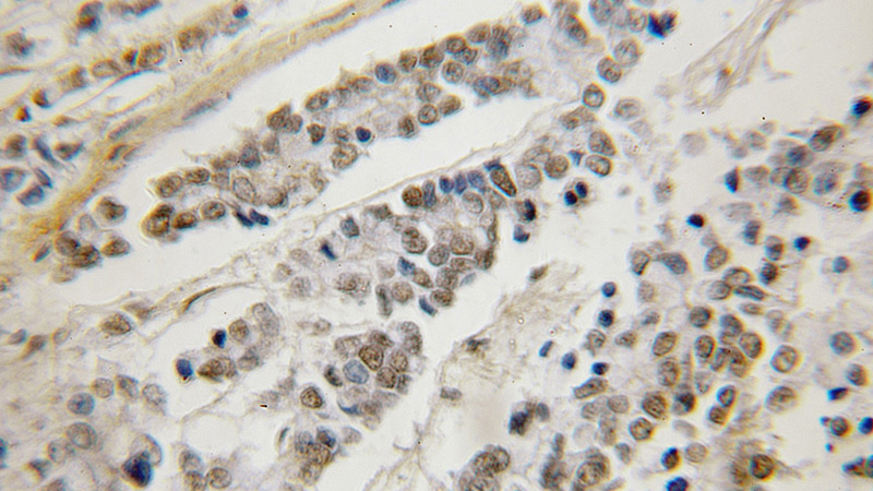 Immunohistochemical of paraffin-embedded human colon cancer using Catalog No:113374(NUP133 antibody) at dilution of 1:50 (under 10x lens)