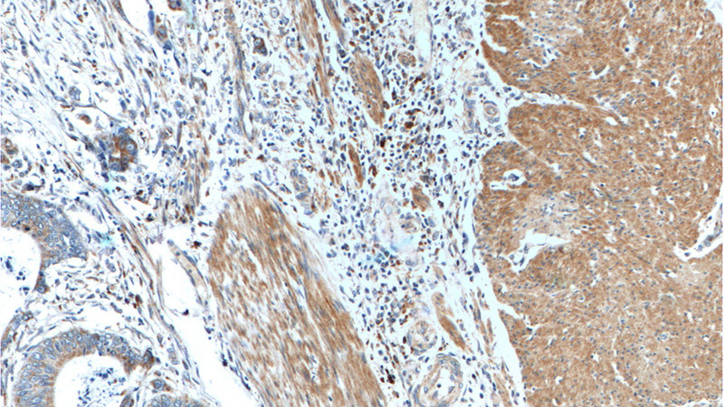 Immunohistochemistry of paraffin-embedded human colon cancer tissue slide using Catalog No:115385(C11orf75 Antibody) at dilution of 1:200 (under 40x lens).