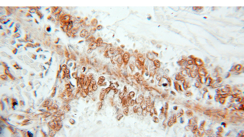 Immunohistochemical of paraffin-embedded human ovary tumor using Catalog No:115758(SYCE1 antibody) at dilution of 1:50 (under 10x lens)