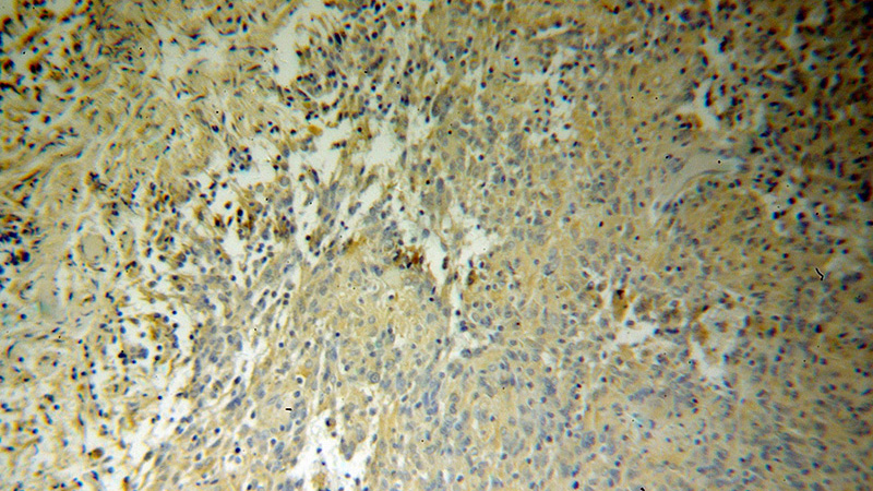 Immunohistochemical of paraffin-embedded human gliomas using Catalog No:114437(RAB39 antibody) at dilution of 1:100 (under 10x lens)