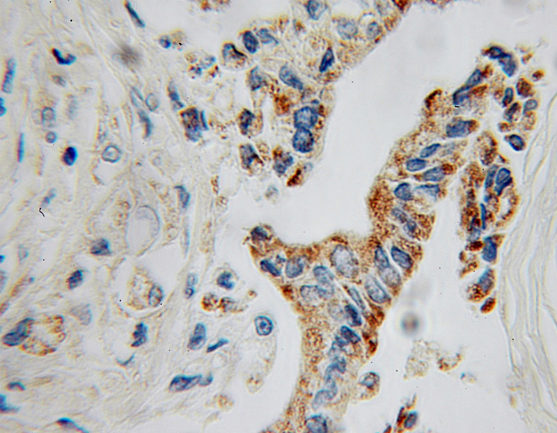 Immunohistochemical of paraffin-embedded human pancreas cancer using Catalog No:110887(GATM antibody) at dilution of 1:100 (under 10x lens)
