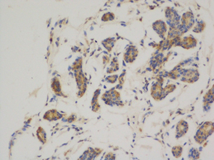Immunohistochemical analysis of paraffin-embedded Human breast cancer. 1, Using Bcl-2 Mouse mAb (YM3041) diluted at 1:200 (4°,overnight). 2, High-pressure and temperature Citric acid, pH6.0 was used for anbitody retrieval. 3,Secondary antibody was diluted at 1:200(room temperature, 50min). Picture was kindly provided by our customer from Tianjin Medical University Cancer Institute and Hospital