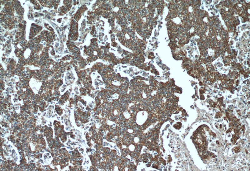 Immunohistochemical of paraffin-embedded human prostate cancer using Catalog No:115580(SPON2 antibody) at dilution of 1:50 (under 10x lens)
