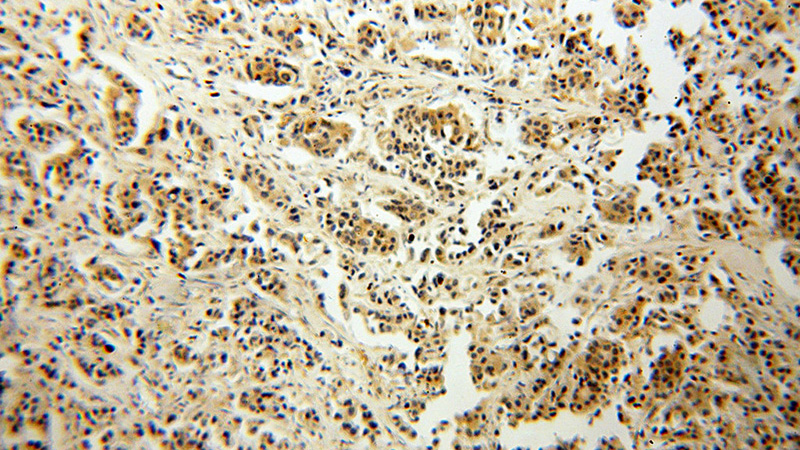 Immunohistochemical of paraffin-embedded human breast cancer using Catalog No:114075(P11 antibody) at dilution of 1:100 (under 10x lens)