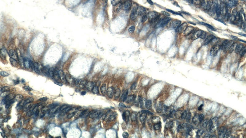 Immunohistochemical of paraffin-embedded human colon using Catalog No:114009(PLS1 antibody) at dilution of 1:50 (under 40x lens)
