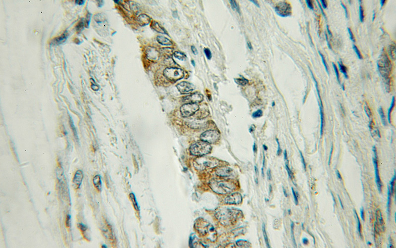Immunohistochemical of paraffin-embedded human colon cancer using Catalog No:116310(TRIM31 antibody) at dilution of 1:50 (under 10x lens)