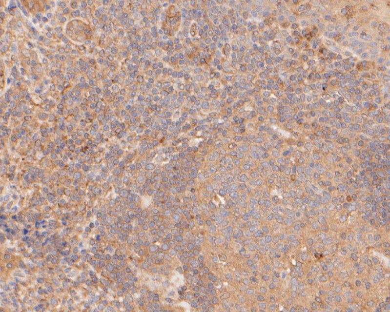 Fig4: Immunohistochemical analysis of paraffin-embedded human tonsil tissue using anti-Gasdermin D antibody. The section was pre-treated using heat mediated antigen retrieval with sodium citrate buffer (pH 6.0) for 20 minutes. The tissues were blocked in 5% BSA for 30 minutes at room temperature, washed with ddH2O and PBS, and then probed with the primary antibody ( 1/50) for 30 minutes at room temperature. The detection was performed using an HRP conjugated compact polymer system. DAB was used as the chromogen. Tissues were counterstained with hematoxylin and mounted with DPX.