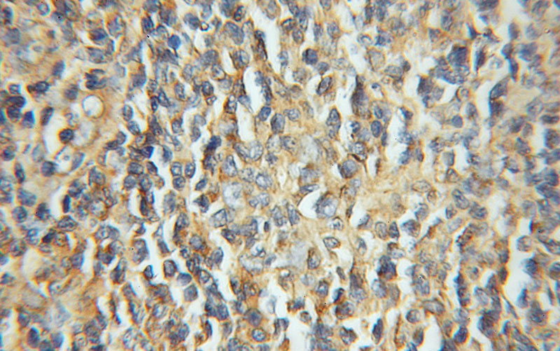 Immunohistochemical of paraffin-embedded human lymphoma using Catalog No:112220(LIAS antibody) at dilution of 1:100 (under 40x lens)