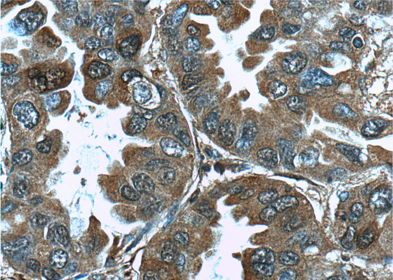 Immunohistochemistry of paraffin-embedded human lung cancer tissue slide using Catalog No:114461(RAB8B Antibody) at dilution of 1:50 (under 40x lens)