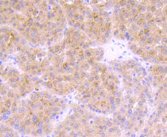 Fig3: Immunohistochemical analysis of paraffin-embedded human liver cancer tissue using anti-TrkA antibody. Counter stained with hematoxylin.