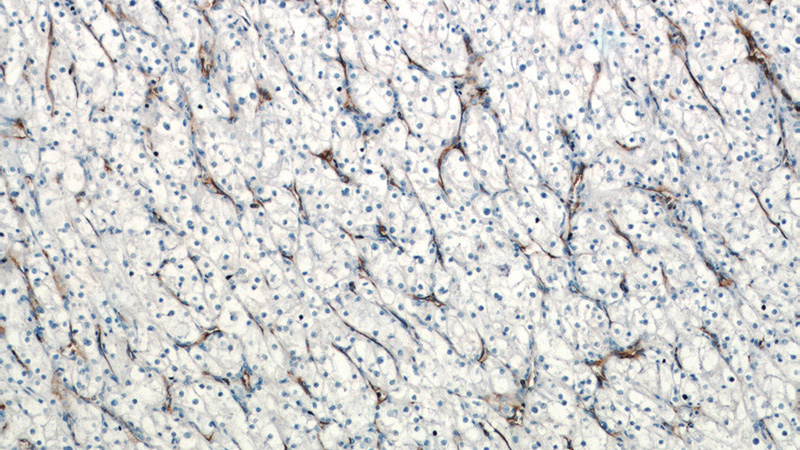 Immunohistochemistry of paraffin-embedded human renal cell carcinoma tissue slide using Catalog No:109025(CD31 Antibody) at dilution of 1:400 (under 10x lens)