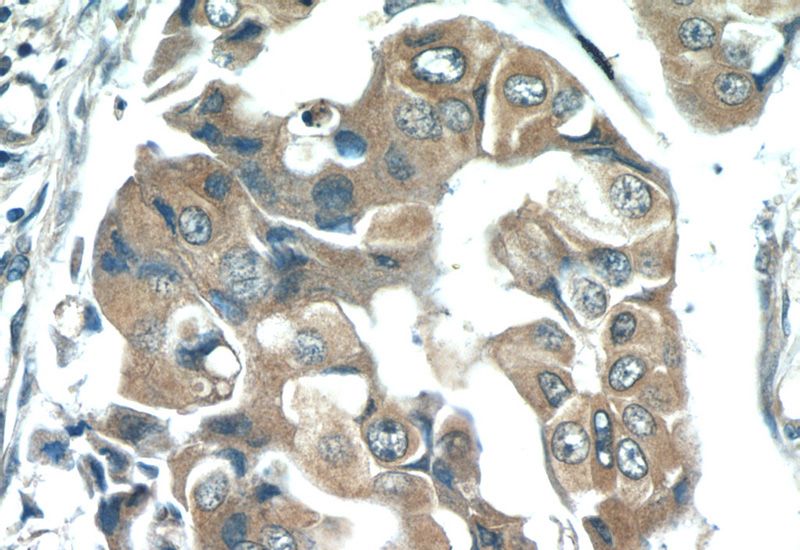 Immunohistochemistry of paraffin-embedded human breast cancer tissue slide using Catalog No:107074(AZGP1 Antibody) at dilution of 1:50 (under 40x lens)