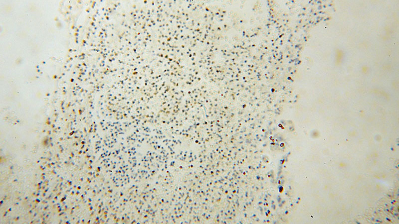 Immunohistochemical of paraffin-embedded human colon cancer using Catalog No:110434(FA2H antibody) at dilution of 1:50 (under 10x lens)