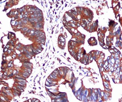 Immunohistochemical analysis of paraffin-embedded Colorectal cancer using BiP/GRP78 (C-terminus) Mouse mAb (1/100 dilution).Antigen retrieval was performed by pressure cooking in citrate buffer (pH 6.0).
