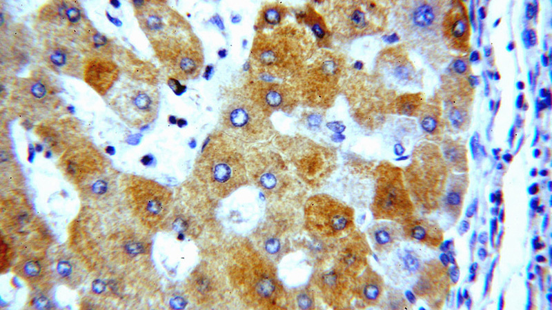 Immunohistochemical of paraffin-embedded human hepatocirrhosis using Catalog No:113065(NDUFA9 antibody) at dilution of 1:50 (under 40x lens)