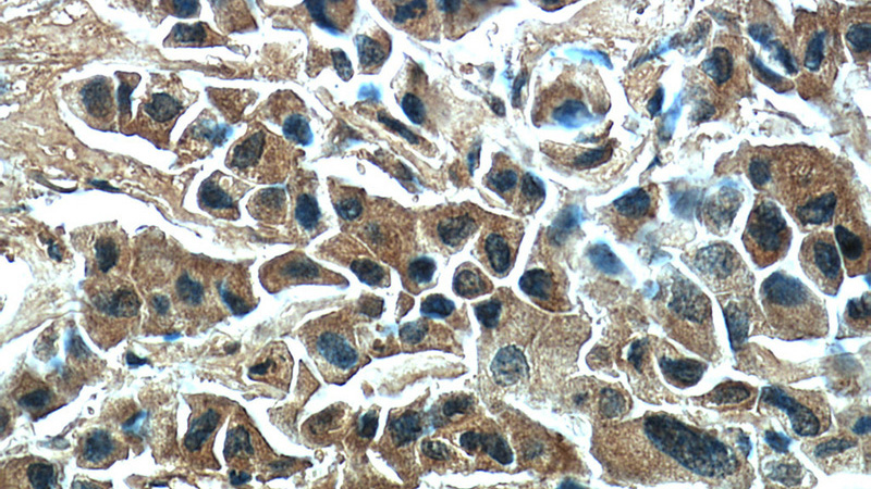Immunohistochemical of paraffin-embedded human breast cancer using Catalog No:114748(RNF170 antibody) at dilution of 1:50 (under 40x lens)