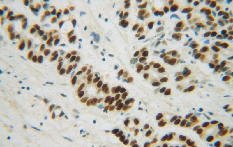 Immunohistochemical of paraffin-embedded human gliomas using Catalog No:112516(METTL1 antibody) at dilution of 1:100 (under 40x lens)