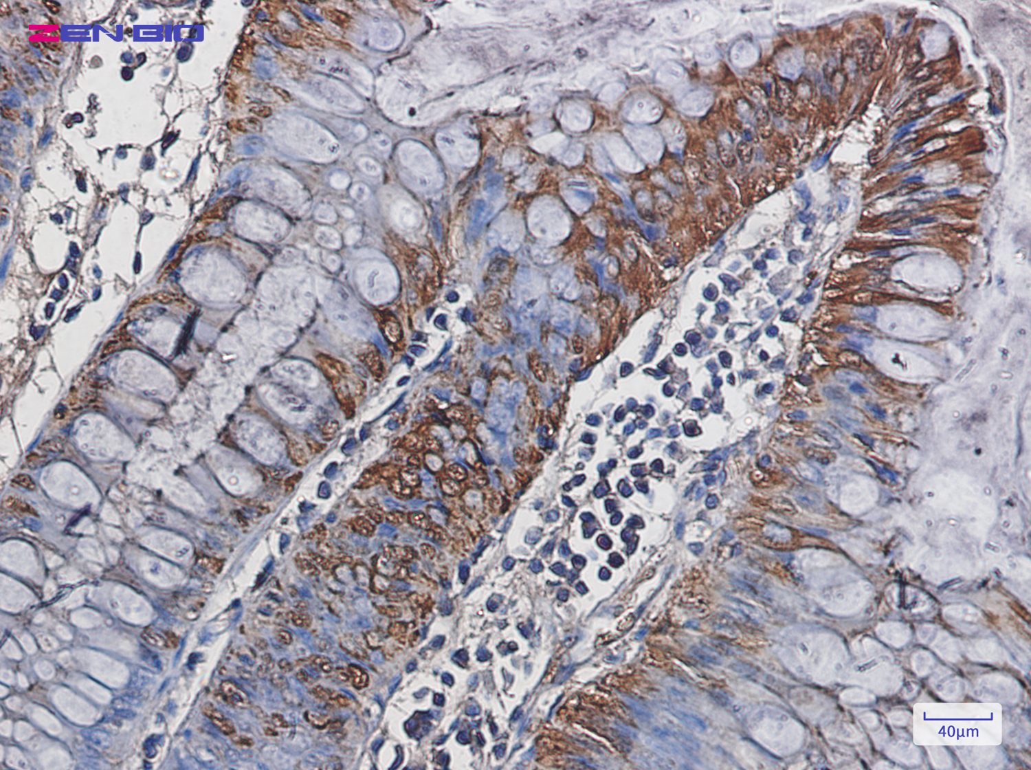 Immunohistochemistry of Carbonic Anhydrase I in paraffin-embedded Human colon cancer tissue using Carbonic Anhydrase I Rabbit pAb at dilution 1/50