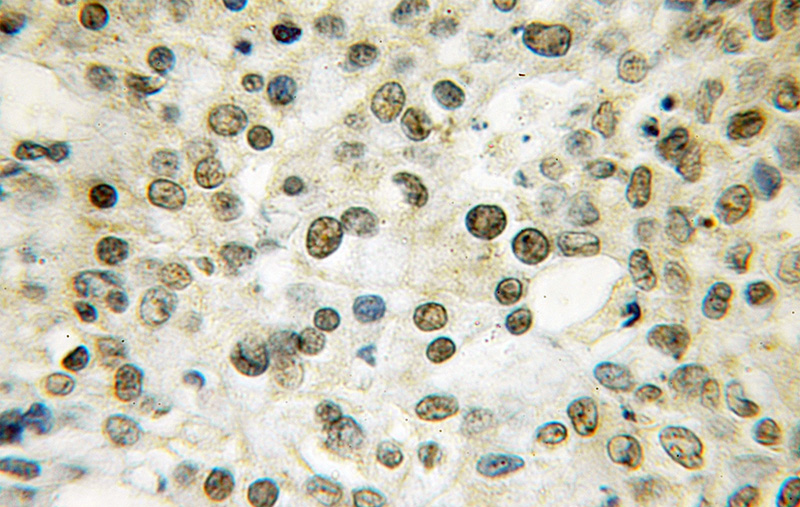 Immunohistochemical of paraffin-embedded human colon cancer using Catalog No:116037(THAP1 antibody) at dilution of 1:50 (under 40x lens)
