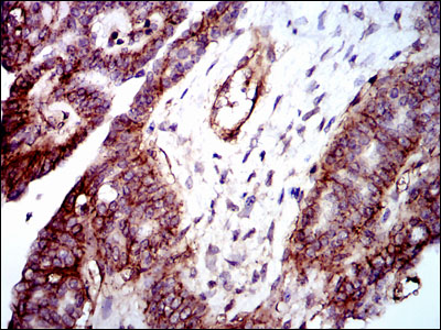 Immunohistochemical analysis of paraffin-embedded ovarian cancer tissues using ITGB1 mouse mAb with DAB staining.