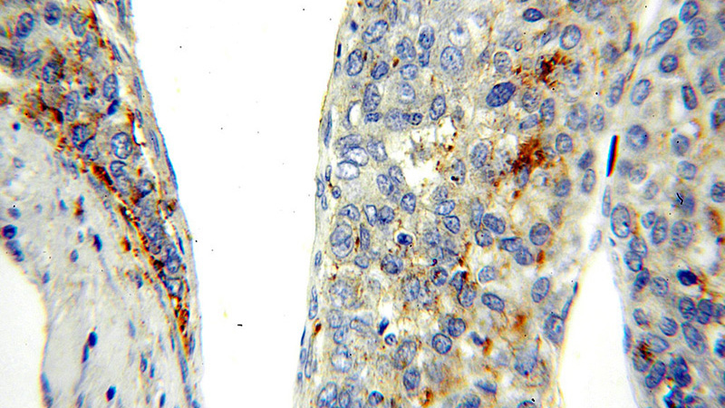 Immunohistochemical of paraffin-embedded human liver cancer using Catalog No:114426(RAB27A-specific antibody) at dilution of 1:50 (under 40x lens)