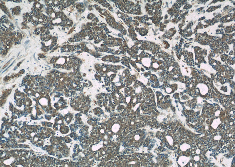 Immunohistochemical of paraffin-embedded human cervical cancer using Catalog No:107428(MMS19 antibody) at dilution of 1:50 (under 10x lens)