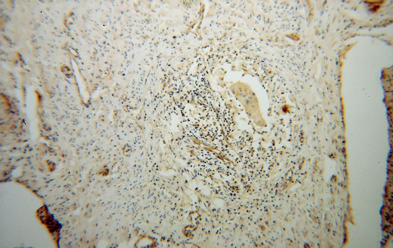 Immunohistochemical of paraffin-embedded human cervical cancer using Catalog No:115690(STAT4 antibody) at dilution of 1:100 (under 10x lens)