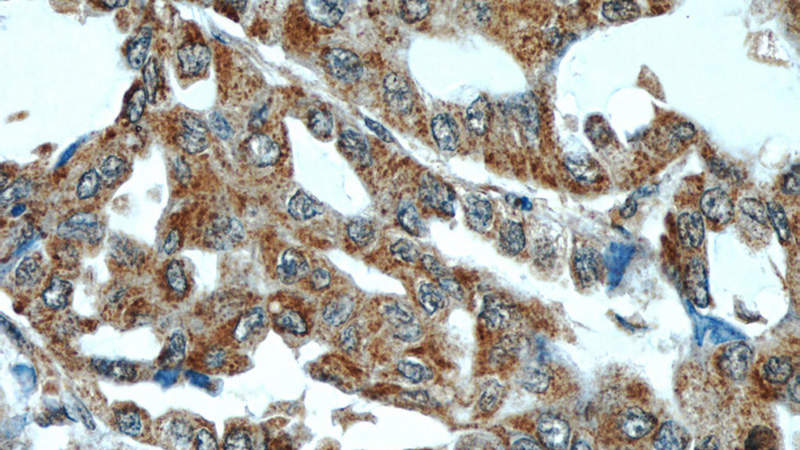Immunohistochemical of paraffin-embedded human lung cancer using Catalog No:111798(INHBA antibody) at dilution of 1:50 (under 40x lens)