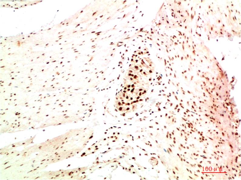 Immunohistochemical analysis of paraffin-embedded Human Colon Carcinoma Tissue using HP-1α Mouse mAb diluted at 1:200.