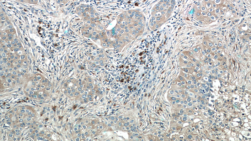 Immunohistochemistry of paraffin-embedded human breast cancer tissue slide using Catalog No:109641(CXCL17 Antibody) at dilution of 1:50 (under 10x lens)