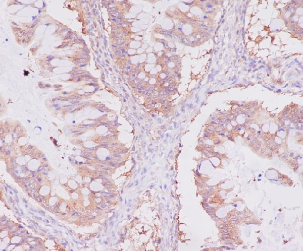 Immunohistochemical analysis of paraffin-embedded human uterus cancer, using NSE Antibody.