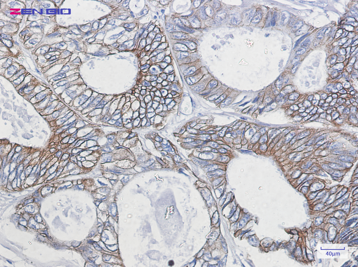 Immunohistochemistry of Cytokeratin 18 in paraffin-embedded Human colon cancer tissue using Cytokeratin 18 Rabbit pAb at dilution 1/50