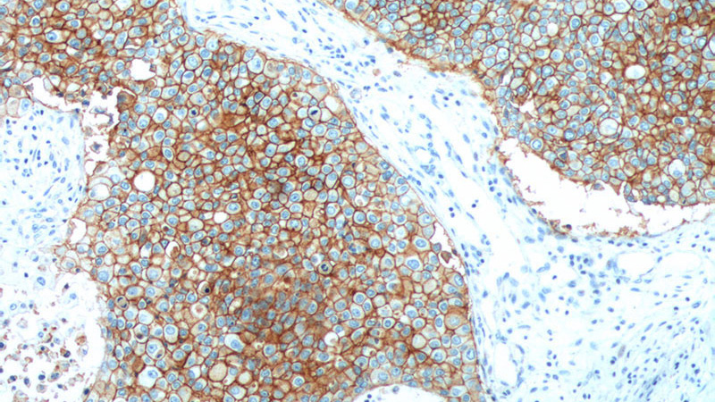 Immunohistochemistry of paraffin-embedded human breast cancer tissue slide using (EPCAM Antibody) at dilution of 1:500 (under 10x lens). Heat mediated antigen retrieved with Tris-EDTA buffer(pH9).