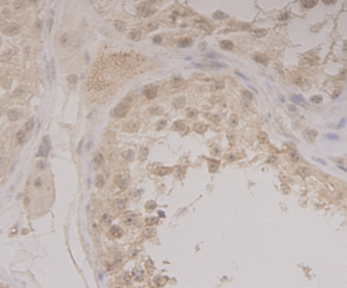 Fig3: Immunohistochemical analysis of paraffin-embedded human tonsil tissue using anti-GRAMD1A antibody. Counter stained with hematoxylin.