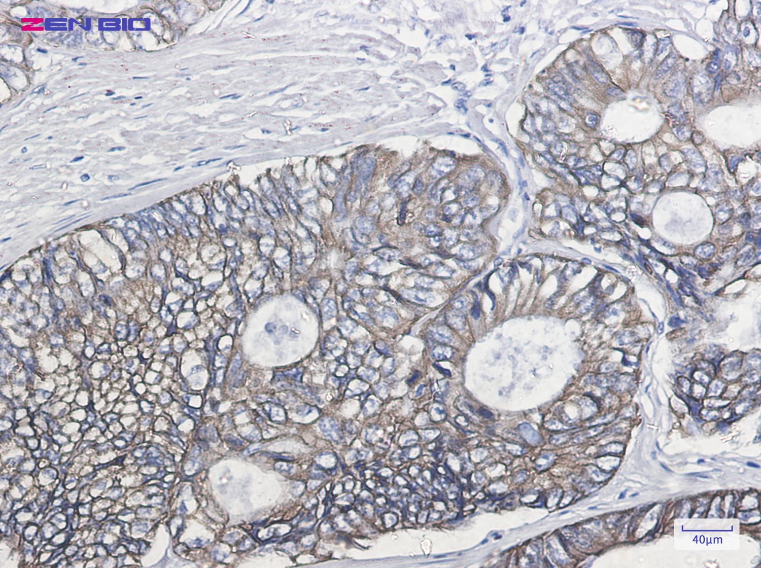 Immunohistochemistry of Cytokeratin 19 in paraffin-embedded Human colon cancer tissue using Cytokeratin 19 Rabbit pAb at dilution 1/20